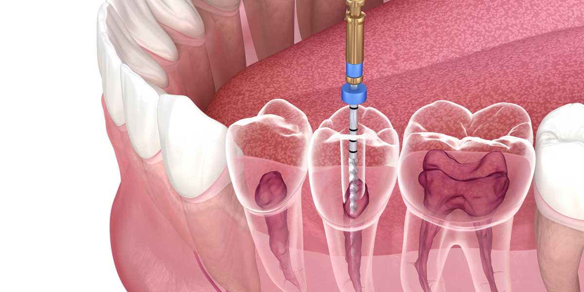 Advanced Dentistry of Nevada, MO Advanced Dentistry of Nevada, MO